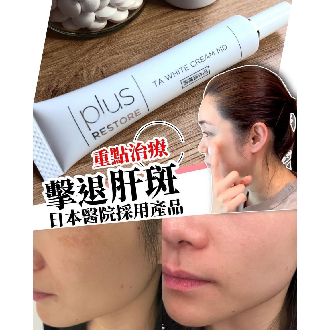 $210/1。日本 醫療級 黑斑救星 10g